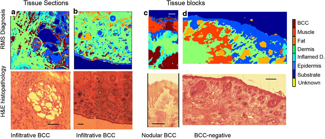 Typical examples of basal cell carcinoma (BCC) by raster scanning Raman micro-spectroscopy (RMS). 