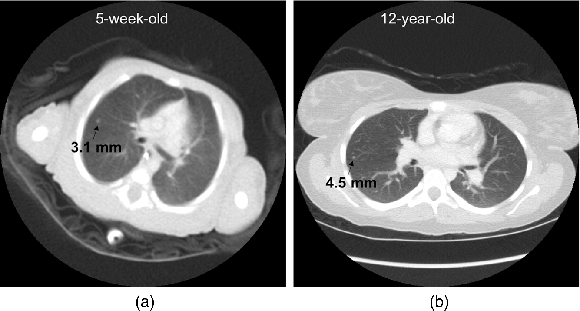 Fig. 3, Effect of reconstruction FOV size on the displayed diameter of a nodule. doi:10.1117/1.JMI.4.3.031209