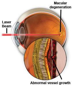 laser photocoaculation