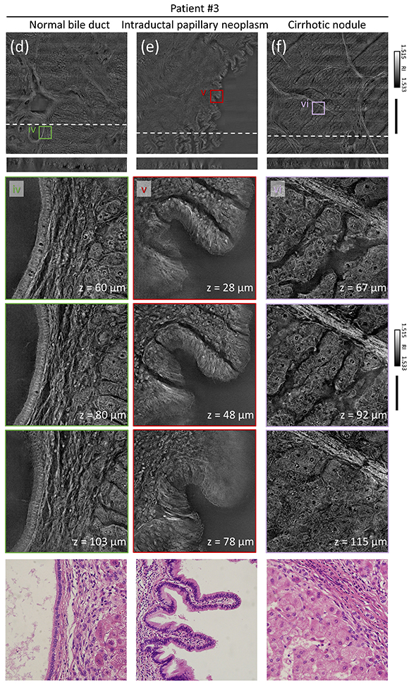 Volumetric histopathology of unlabeled 100-μm-thick pancreas tissue sample 