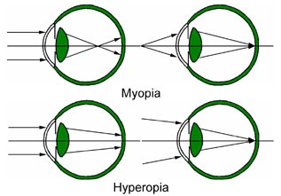 myopia hyperopia and astigmatism explained)