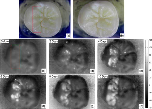 Demineralization of molar