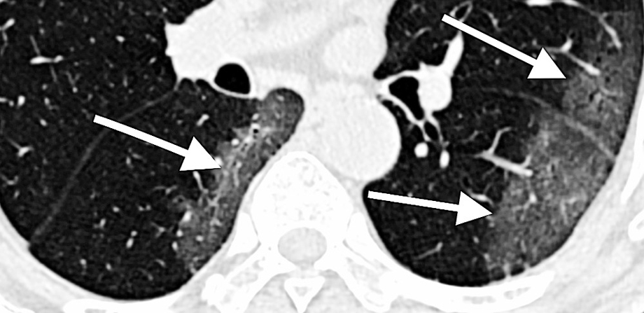 CT scan of lungs of COVID-19 patient 