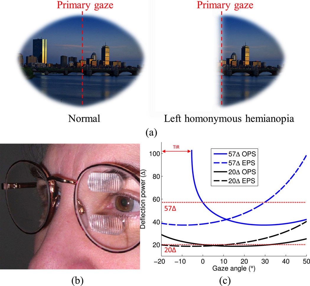 Prism Lenses  Treatment of Double Vision and Visual Field Loss
