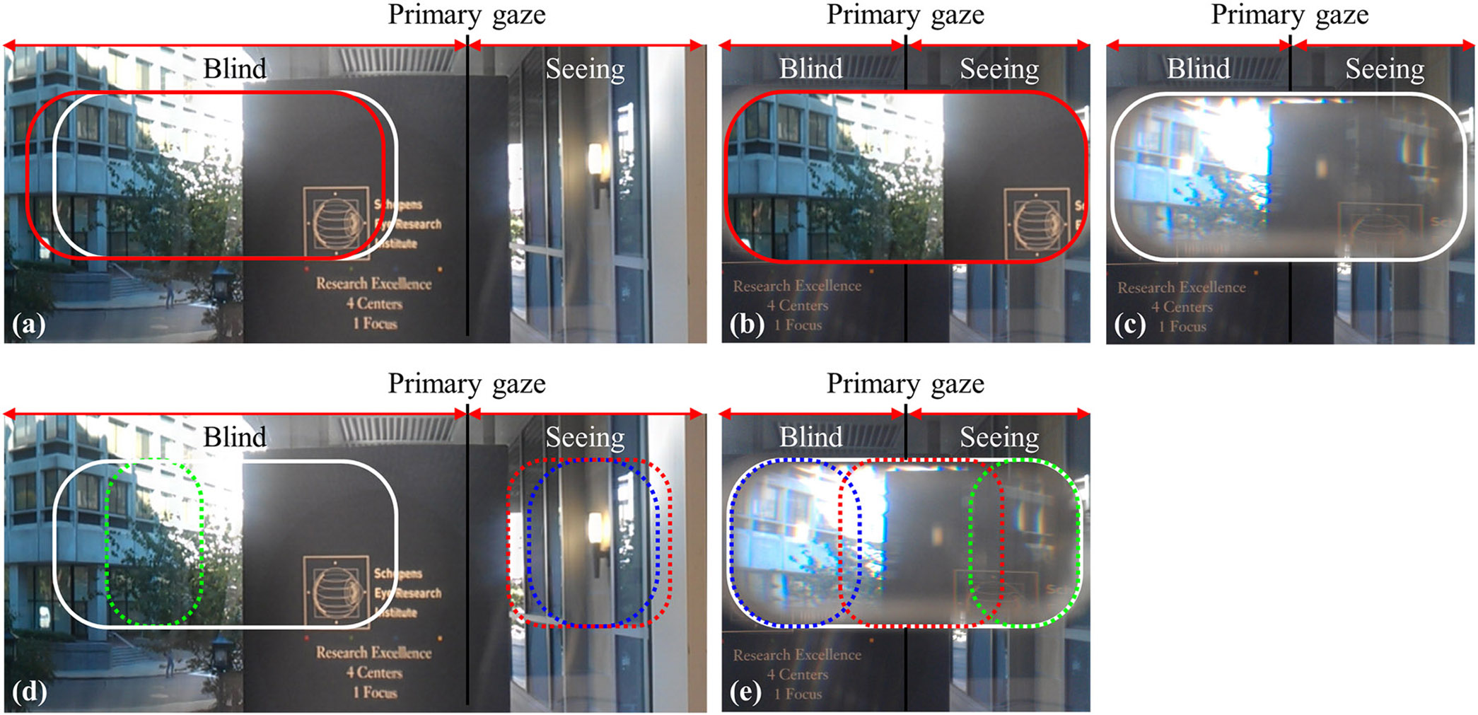 High-Power Prismatic Glasses Can Expand Visual Fields up to 30